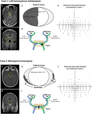 Case Report: Visual Rehabilitation in Hemianopia Patients. Home-Based Visual Rehabilitation in Patients With Hemianopia Consecutive to Brain Tumor Treatment: Feasibility and Potential Effectiveness